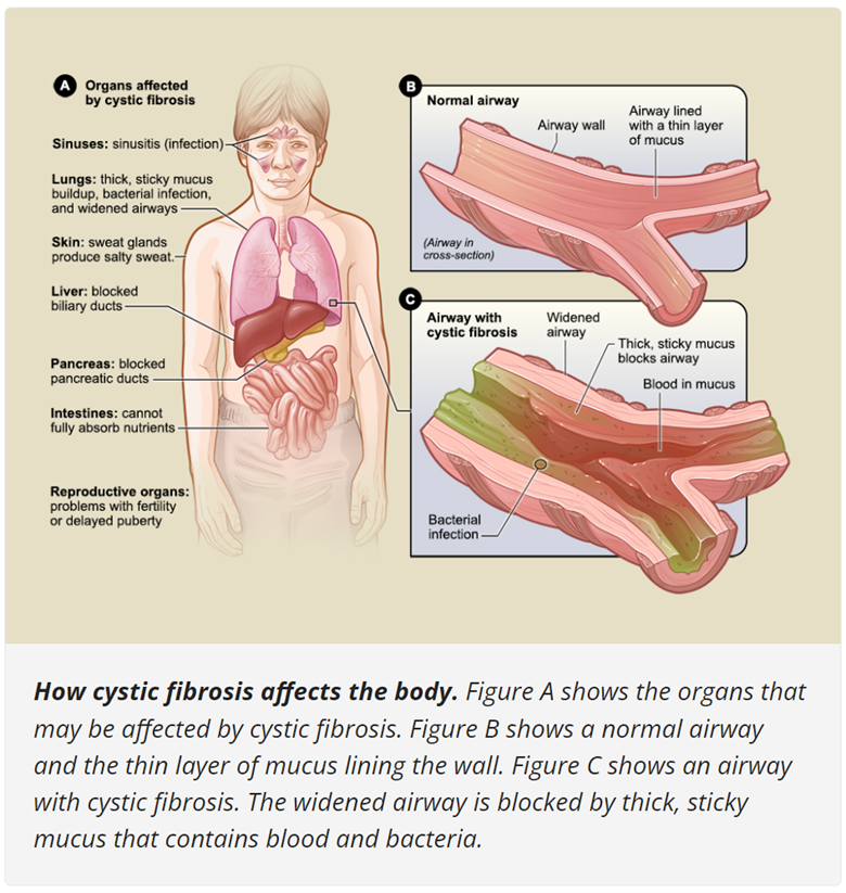 Organs Affected by Cystic Fibrosis