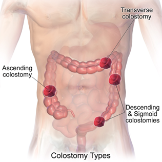 Colostomy Types illustration