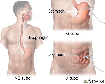 Tube Feeding Illustrations